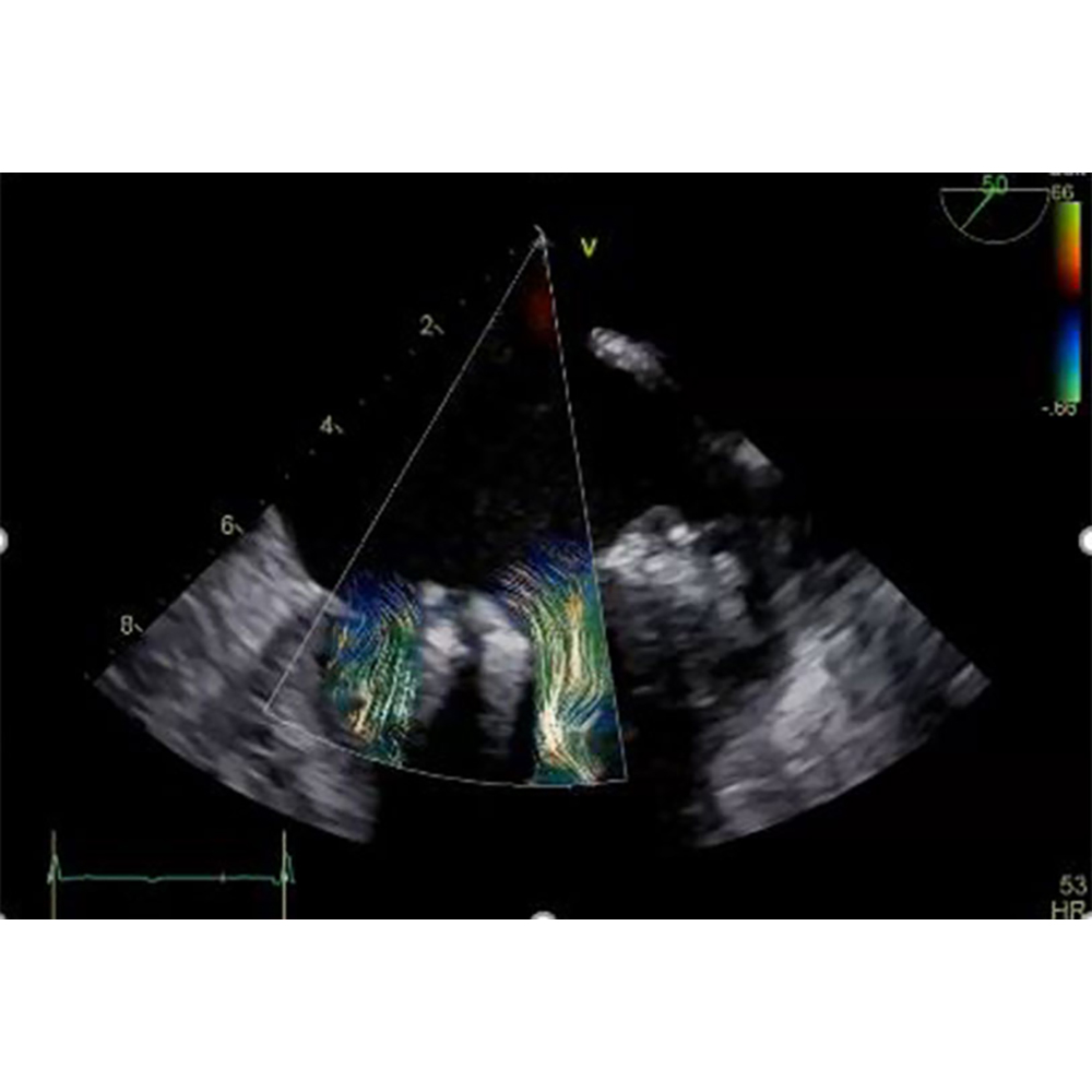 Blood Speckle Imaging (BSI) on Vivid Blood Speckle Imaging (BSI) on Vivid